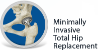 Minimally Invasive Joint Replacement