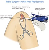 Nivo Incision Illustration